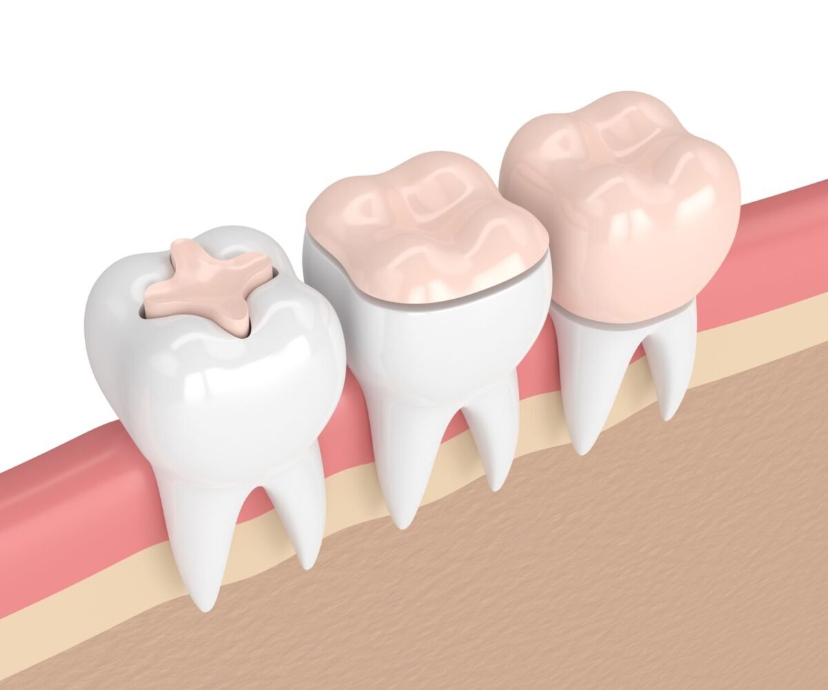 Dental Crowns